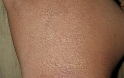 De ganglion van mevr. Bakker